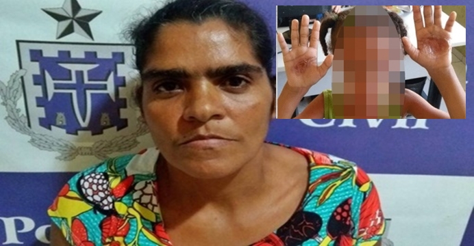 Criança de seis anos tem mãos queimadas com colher quente em Amélia Rodrigues