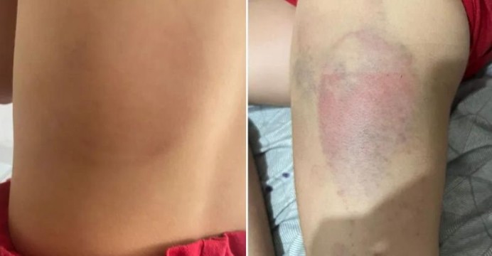 Pai deixa filha com diversos hematomas e faz ameaças para que ela não conte à mãe