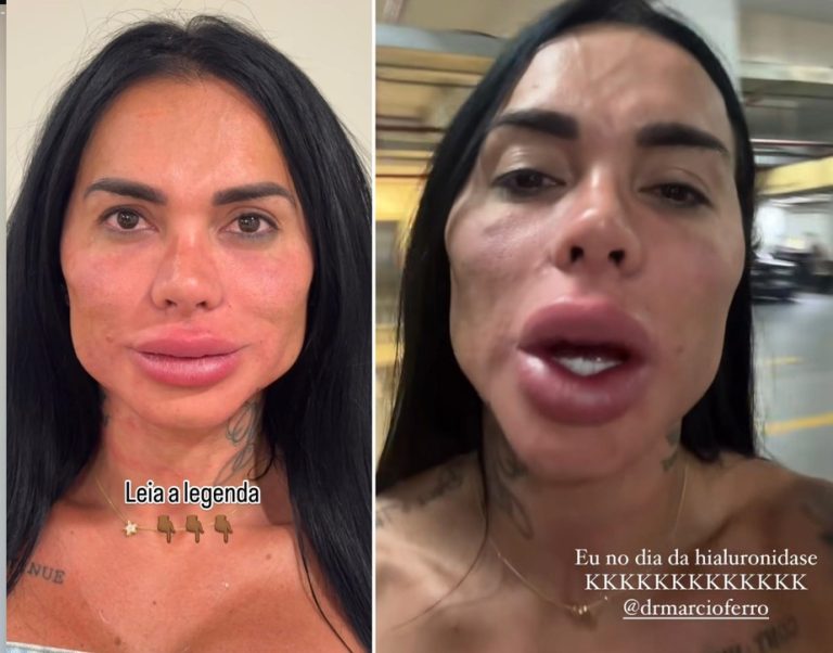 Kamila Simioni mostra rosto após nova harmonização facial: ‘A boca dos sonhos’